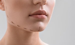 Up to 76% Off Double-Chin Treatment at Skinovatio Medical Spa
