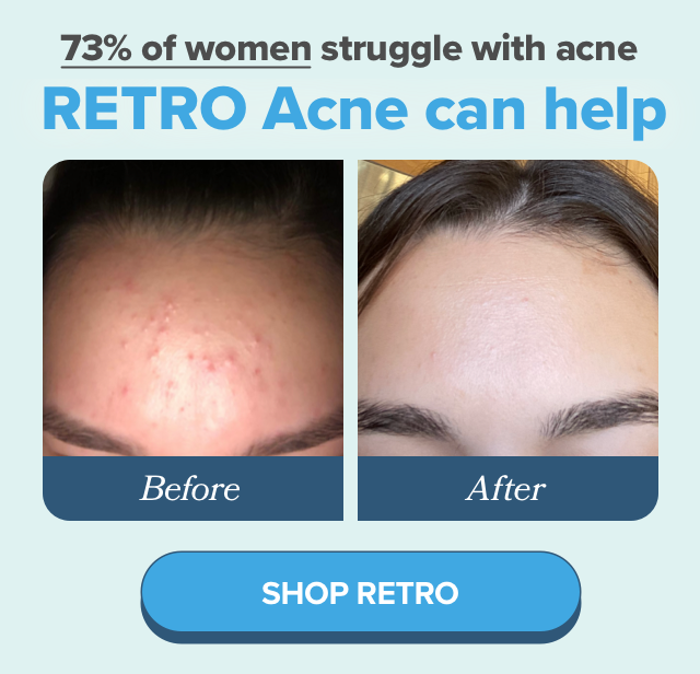 73% of women struggle with acne, RETRO Acne can help